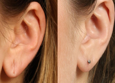 Minor skin procedures by cosmetologist in Gurgaon